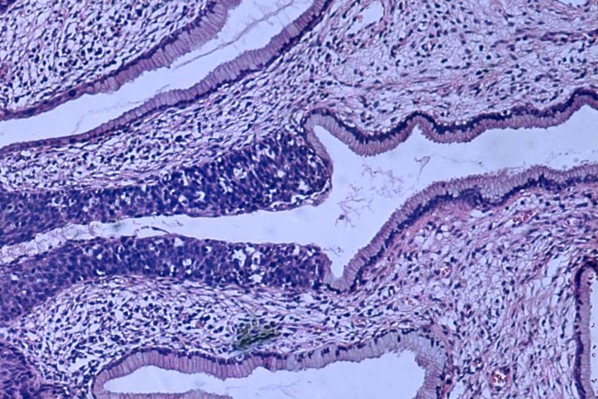 Le risque de cancer du col de l’utérus est deux fois plus élevé chez les femmes atteintes de maladie mentale