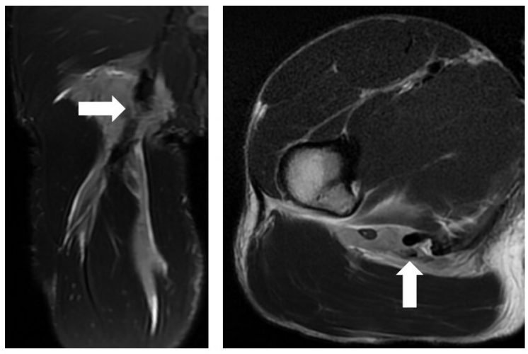 a169cdf408b14993eea3a0882a58 Larmes à Tokyo: les blessures musculaires et tendineuses pendant la compétition olympique peuvent causer un chagrin